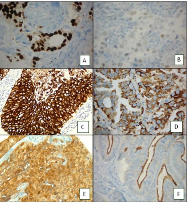 Figura  5:  Exemplos  de  diferentes  tipos  de  expressão:  A:  Expressão  nuclear  de  receptor  de  estrogênio,  fortemente  positivo  em  carcinoma  ductal  de  mama,  B:  Expressão  nuclear  de  receptor  de  estrogênio,  intensidade  fraca  porém  po