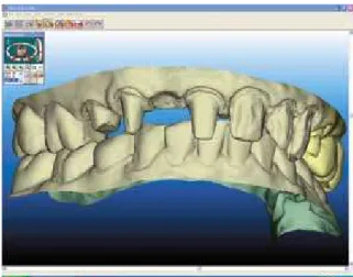 FIGURE 2 - iTero scanner. FIGURE 3 - Image showing the digital model for prosthetic dentistry.