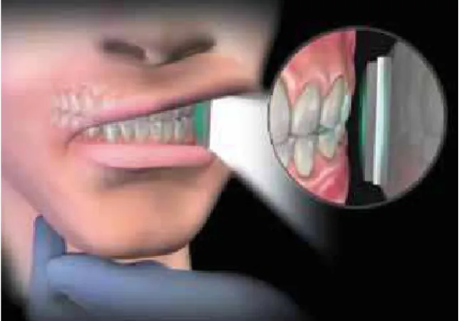 FIGURE 4 - Image showing a digital model for Orthodontics. FIGURE 5 - Using the digital scanner to take a checkbite impression.
