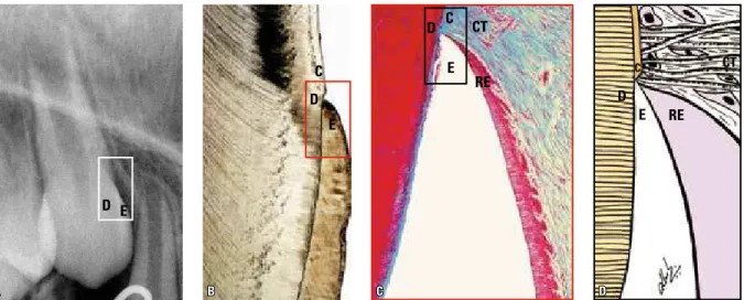 FIGURE 1 - The cervical region is a sensitive tooth structure due to the fragile junction between enamel and cementum (rectangles)