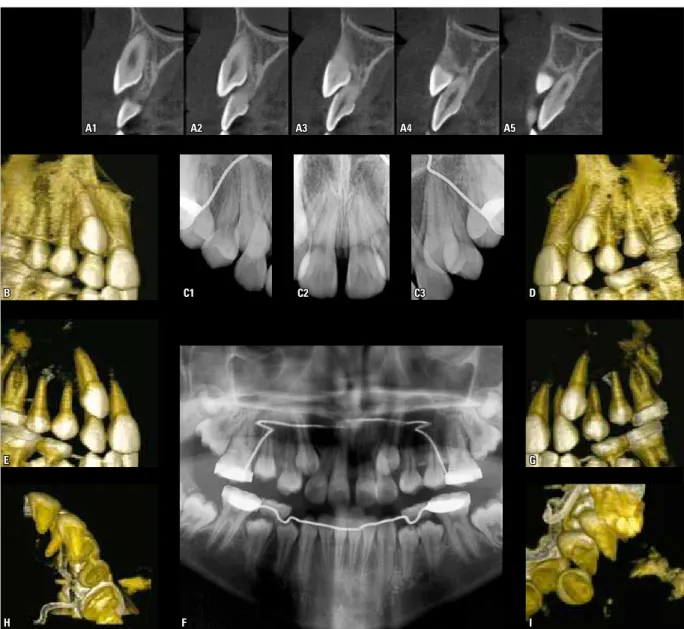 FIGURE 3 - Imaging aspects of unerupted maxillary canines, their position and relationship with adjacent teeth, as well as their spatial individualization  providing a view of the cervical region from various observation angles