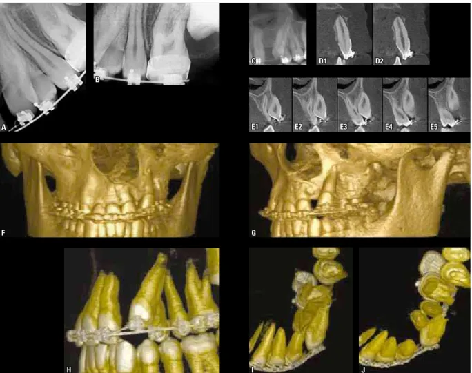 FIGURE 4 - Imaging aspects of unerupted canines undergoing orthodontic traction in cleft patients