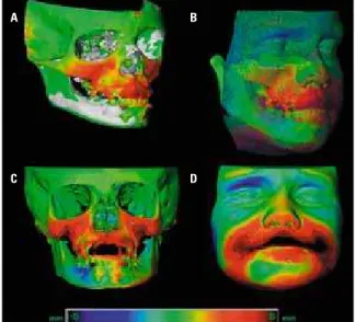 FIGURA 1 - Sobreposições na fossa craniana anterior para avaliar rela- rela-tivo  crescimento  e  resposta  ao  tratamento  ortopédico  com  ancoragem  esquelética  na  maxila  e  mandíbula