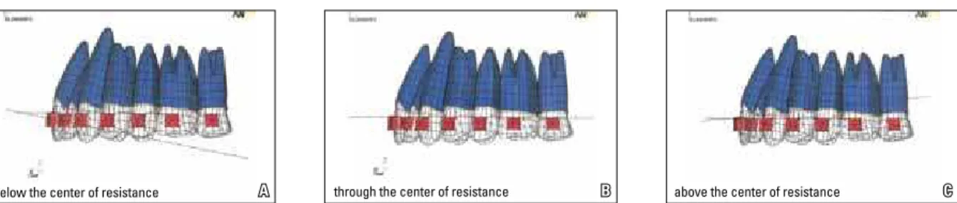 FIGURE 1 - Reproduction of the three models of cervical headgear with different outer bow inclinations in relation to X, Y and Z coordinates, using the Ansys  8.1 program:  A ) BCR (below the center of resistance);  B ) CR (through the center of resistance