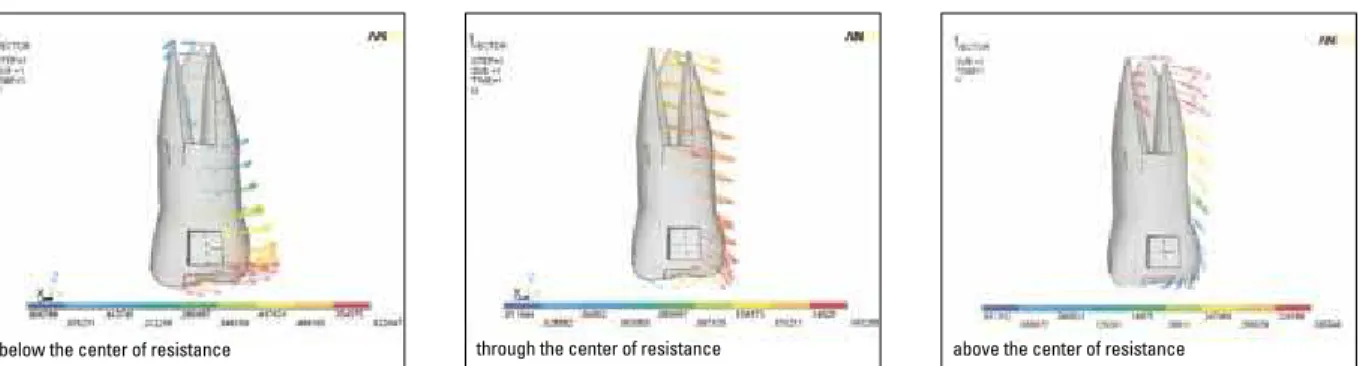 FIGURE 3 - Figure showing the initial distal movement of the first molar in the three computer simulation models