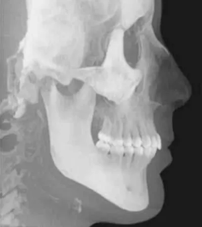 FIGURE 3 - 3D image obtained with the Cone- Cone-Beam Computed Tomography, in lateral view.