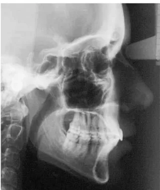 FIGURE 1 - Profile cephalometric radiograph.