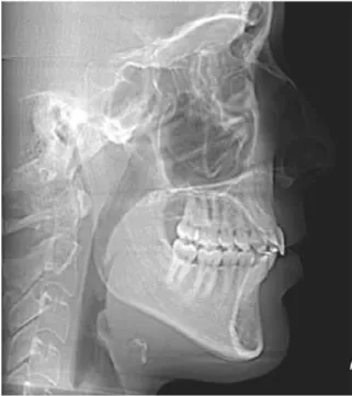 FIGURE 3 - 3D image obtained with the Cone-Beam Computed Tomogra- Tomogra-phy, in lateral view.