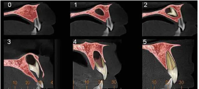 FIGURE 1 - Human permanent dental development stages using CBCT (Sagittal view). 