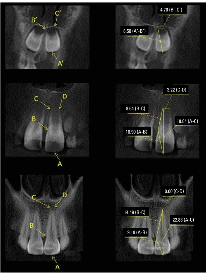 FIGURE 2 - Linear measurements of dental development stages of maxillary central incisor using CBCT (Coronal view)