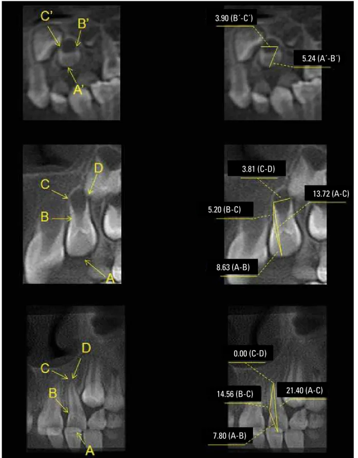 FIGURE 4 - Linear measurements of dental development stages of maxillary lateral incisor using CBCT (Coronal view)