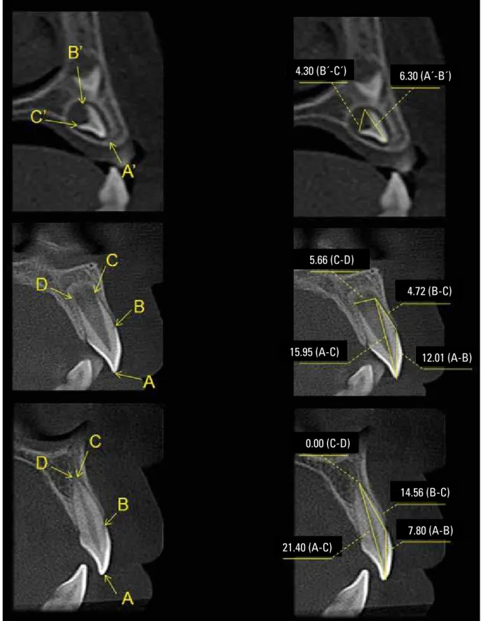 FIGURE 5 - Linear measurements of dental development stages of maxillary lateral incisor using CBCT (Sagittal view)