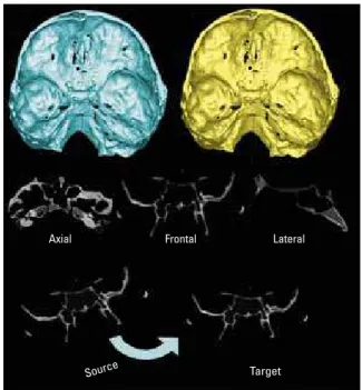 FIGURE  1  -  Registration  of  CBCTs  generated  3D  virtual  models  using  the cranial base surface through a fully automated voxel-wise method