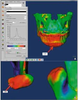 FIGURE 3 - The ISOLINE tool allowed the identification of the greatest dis- dis-placement of a specific anatomic region
