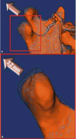 FIGURE  6  -  A)  Mesh-transparencies  visualization  showing  a  condyle  displacement of 3.2 mm after surgery