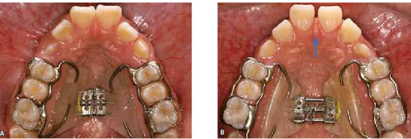 FIGURE 1 - Occlusal oral pictures with the Haas expander appliance: A) Before the beginning of screw activation, B) Immediately after screw stabilization  (blue arrow shows the opening of the inter-incisors diastema).