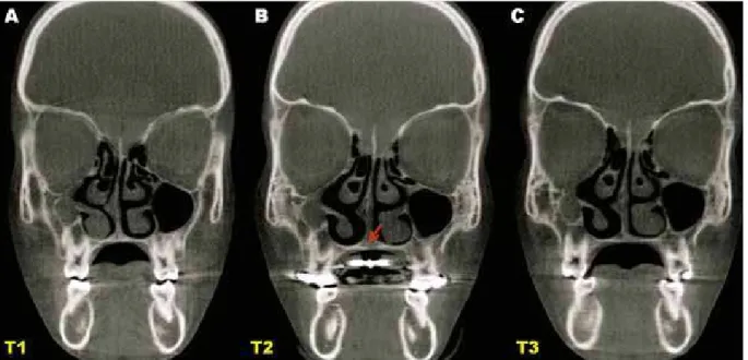 FIGURE 5 - Three-dimensional reconstruction showing the opening of the  midpalatal suture in T2 (Dolphin Imaging ® ).