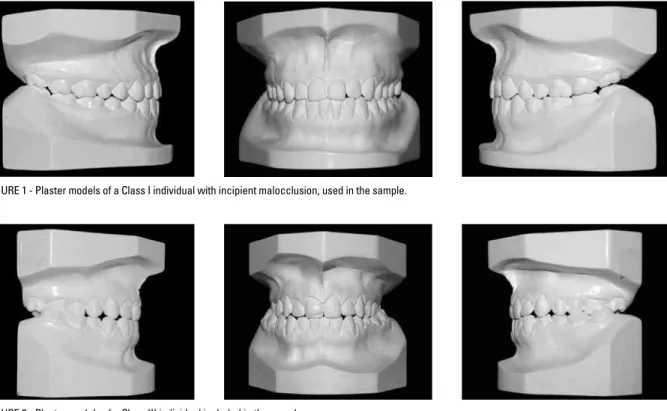 FIGURE 1 - Plaster models of a Class I individual with incipient malocclusion, used in the sample.