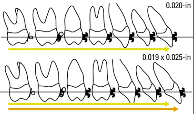 FIGURE 12 - Proclination effect and increase in arch perimeter in the tran- tran-sition from T1 to T2.
