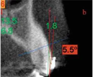 FIGURE 1 - Positive inclination. FIGURE 2 - Negative inclination.