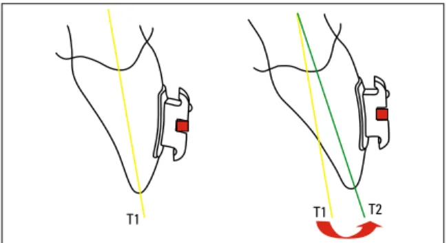 FIGURE 9 - Effect on tooth inclination at T2. Unaffected by the inclination  provided  in  the  prescription,  the  rectangular  0.019  X  0.025-in  archwire  caused labial inclination in order to finish leveling.