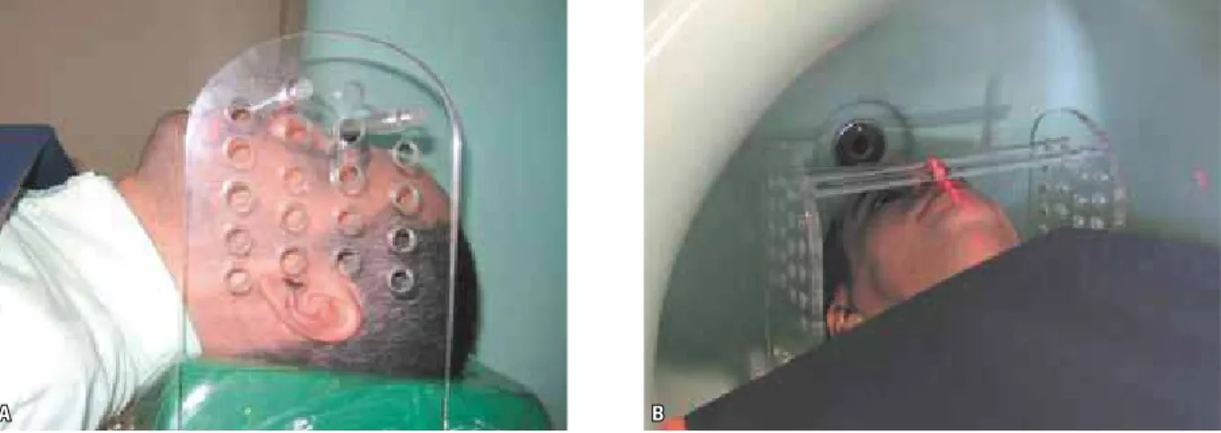 FIGURE 2 - Cone-Beam Computer Tomography scans:  A ) Patient positioned at NewTom 3G with acrylic positioner and Frankfort horizontal plane perpendicular  to the floor;  B ) Using the laser beam to position the facial midline.