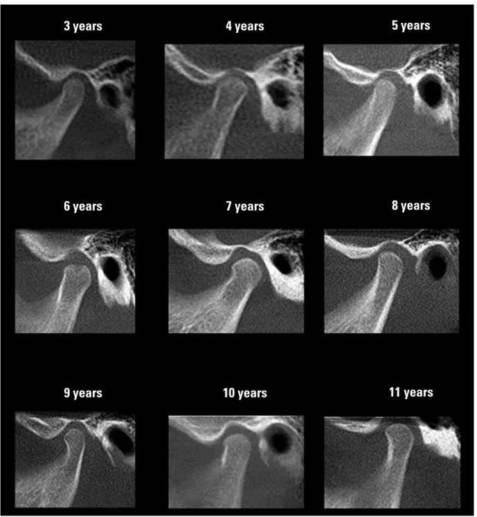 FIGURE 2 - Sequence of morphological variation of the mandibular condyle in lateral view according to age (3 to 20 years old) (continue).