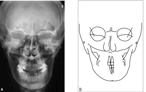 FIGURE 5 - Initial posteroanterior cephalometric radiograph (A) and cephalometric tracing (B)