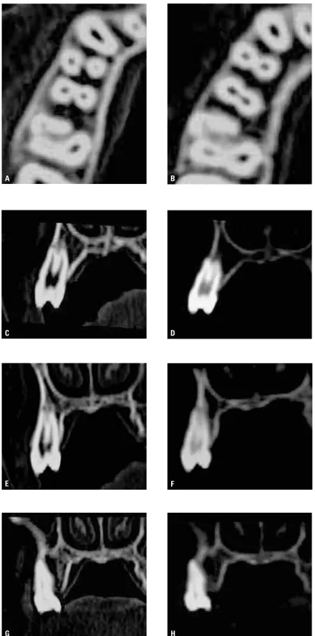 FIGURE  15  -  Periodontal  effects  of  RME.  A,  B)  Maxillary  axial  sections  before  and  after  RME,  respectively