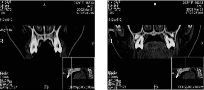 FIGURE 16 - Maxillary external contour on CT coronal reconstruction: A) First premolar area