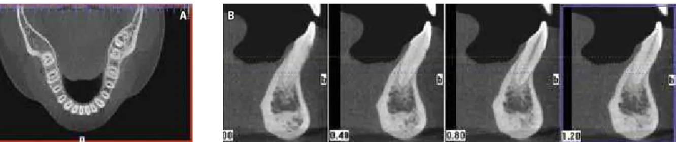 FIGURE 5 - Facial bone dehiscences in the lower incisors in a 21-year-old patient, previously to orthodontic treatment (i-CAT CBCT, voxel size of 0.2 mm)