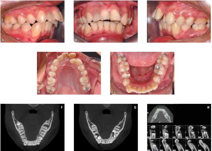 FIGURE 9 - A-E) This case illustrates a Class II malocclusion with maxillary and mandibular anterior crowding