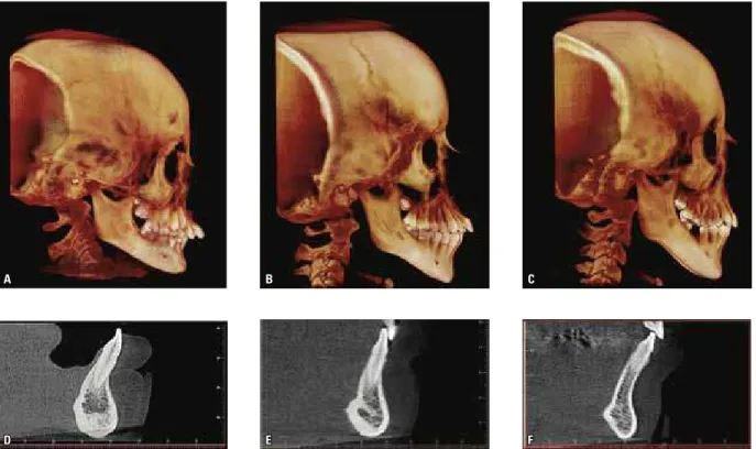 FIGURE 11 - Morphology of mandibular symphysis in different facial types: A and D) Hypodivergent patient; B and E) Normodivergent patient; C and F) Hyper- Hyper-divergent patient.
