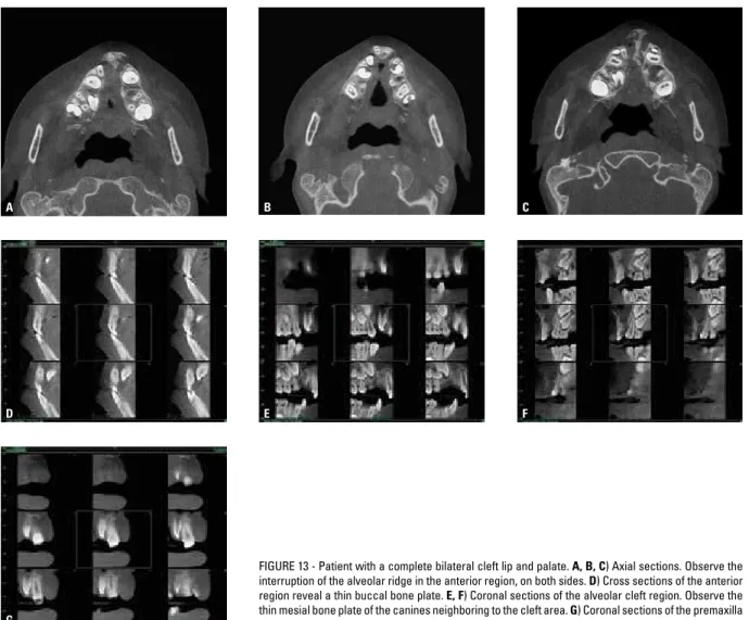 TABLE 1 - Mean and standard deviation for alveolar bone thickness of teeth adjacent to palatal cleft (transforamen bilateral fissure), in mixed dentition  children with mean age of 9 years