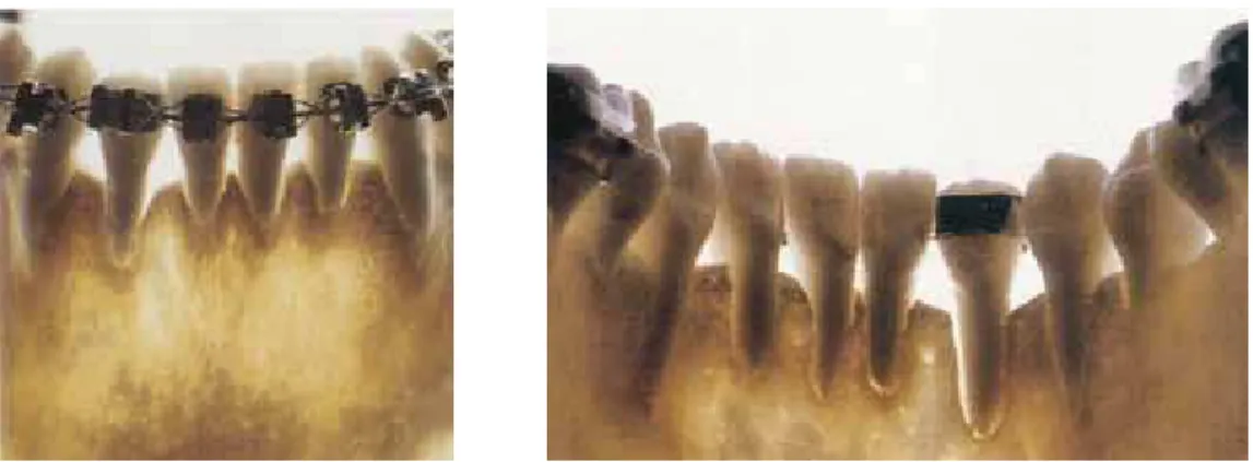 FIGURE 14 - Mandible extracted during autopsy in a young patient who passed away in an accident while the comprehensive orthodontic treatment was been  performed