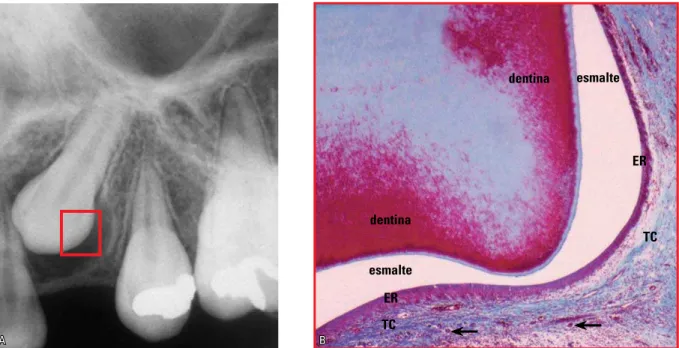 FIGURA 3 - O espaço e o folículo pericoronários nos caninos superiores são lateralmente mais bojudos em função da anatomia coronária, como revela-se  em A