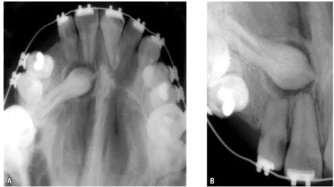 FIGURA 5 - Em alguns casos, a reabsor- reabsor-ção dentária promovida pelos dentes não  irrompidos, inclusive caninos superiores,  nos dentes adjacentes é tardiamente  de-tectada, como ocorreu com esse incisivo  lateral superior