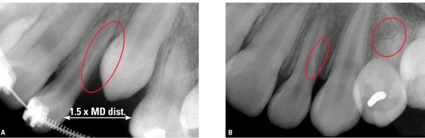 FIGURE 4 - Example of unerupted maxillary canine that did not reach the occlusal plane (A)