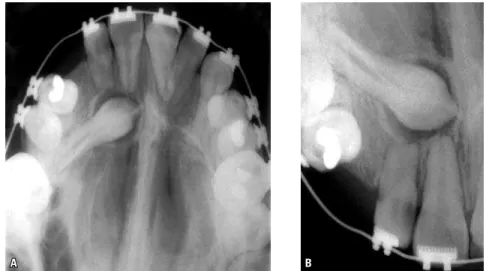 FIGURE  5  -  In  some  cases,  detection  of  the  resorption  caused  by  unerupted  teeth—including  maxillary  canines—in  adjacent teeth only occurs when it is  al-ready too late, as was the case of this  up-per lateral incisor
