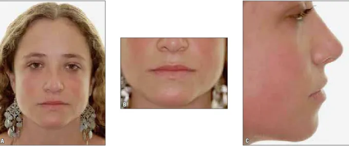FIGURE 1 - Characteristics of the Pattern I face as defined by facial analysis. A) A pleasant frontal morphology of the face results from symmetry and propor- propor-tionality between facial thirds