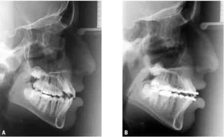 FIGURE 3 - Lateral cephalograms before (A) and after orthodontic treatment (B) of long-faced patient, demonstrating that orthodontics exerts no impact on  dentofacial morphology