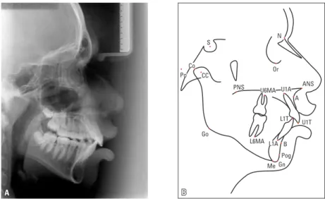 FIGURE 4 - A) Lateral cephalogram, and B) cephalometric tracing illustrating the points used as cephalometric landmarks in a long-faced patient.