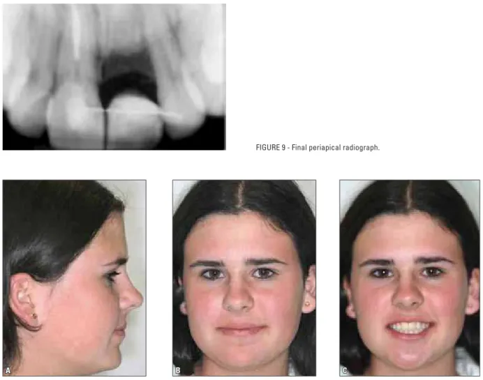 FIGURE 9 - Final periapical radiograph.