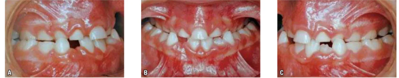 FIGURE 1 -  A ) Right lateral view of the clinical status at diagnosis.  B ) Initial clinical aspect of the case, with the presence of a solitary maxillary central incisor