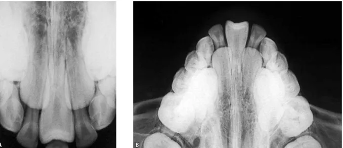 FIGURE 3 -  A ) Periapical radiograph, which confirms the presence of a solitary maxillary central incisor