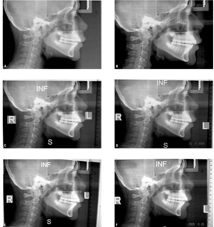FIGURE 3 - A) Direct digital X-ray. B) Image digitized on the HP ScanJet 4C scanner. C, D) Images digitized at 60 cm by the Canon Rebel and Sony W5 cameras,  respectively