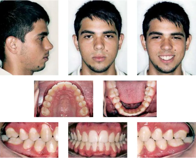 FIGURE 5 - Final facial and intraoral photographs.