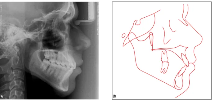 FIGURE 9 - Final lateral cephalometric radiograph (A) and cephalometric tracing (B). 