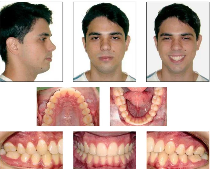 FIGURE 11 - Facial and intraoral control photographs taken two years after treatment completion.
