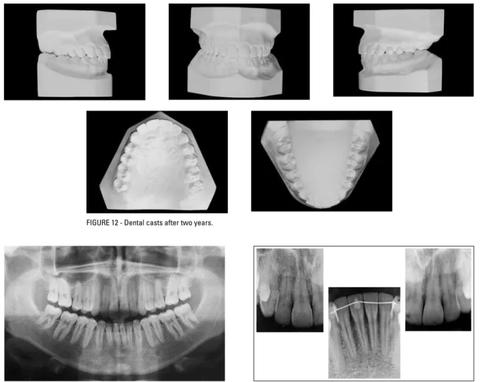 FIGURE 13 - Panoramic radiograph two years after treatment completion. FIGURE 14 - Periapical radiographs two years after treatment completion.